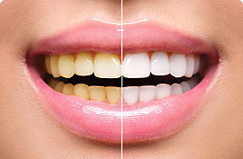 teeth whitening abu dhabi