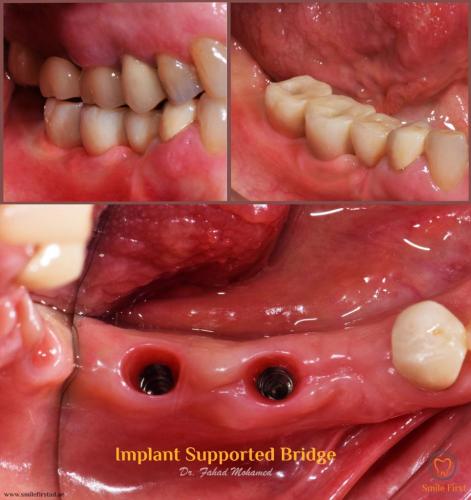 Implants-Crowns-Bridge-and-Veneers.12